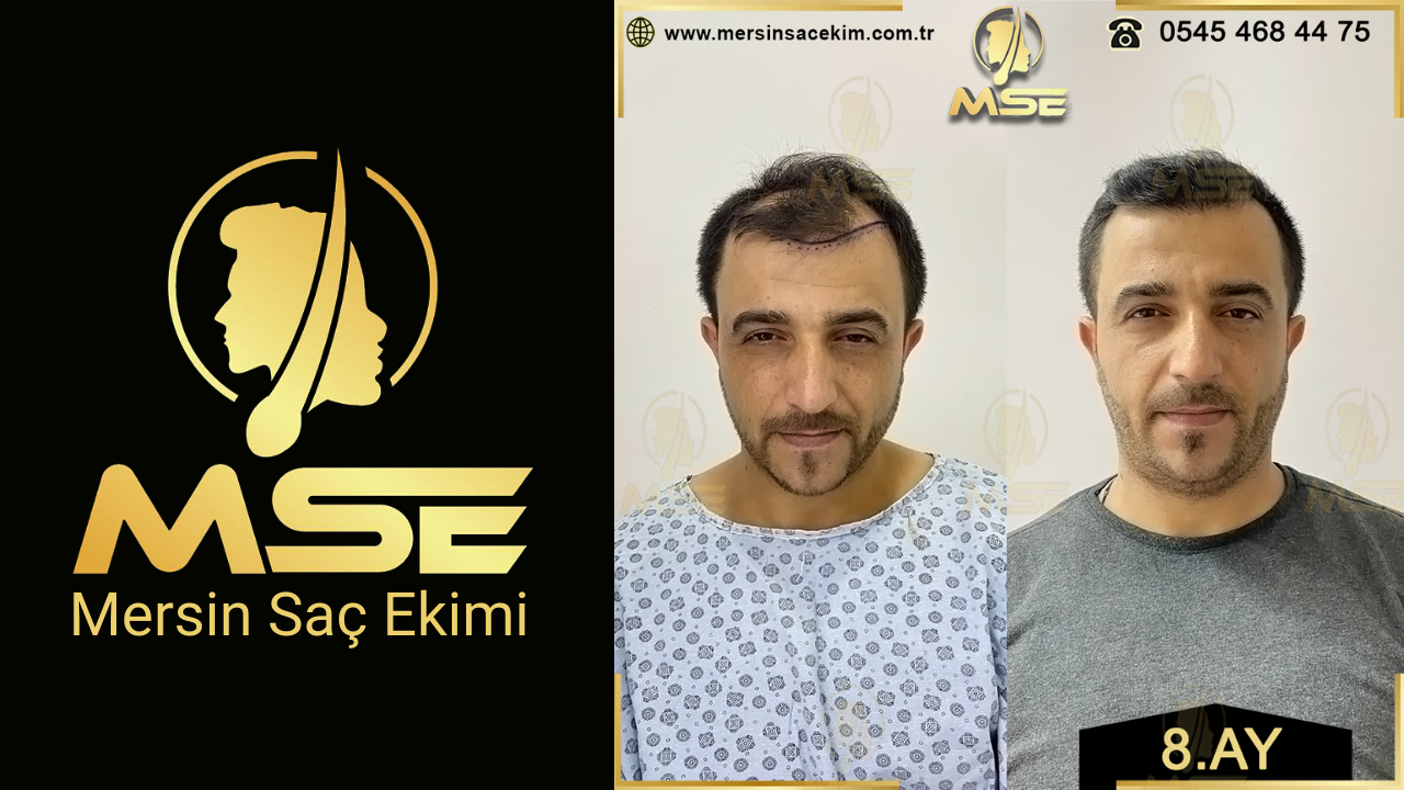 Mersin Saç Ekimi